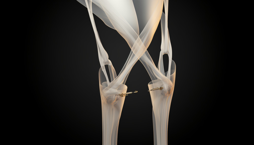 Comment réussir son implant fessier